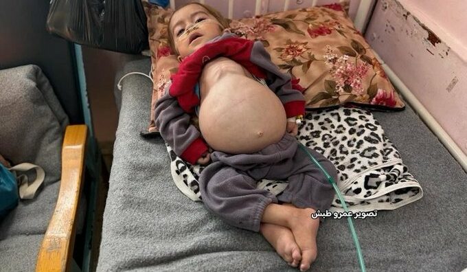 La famine tue aussi à Gaza.